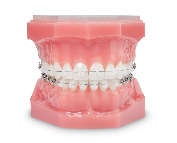Ortodoncia Brackets Castellón - Almela Clínica Dental, Castellón
