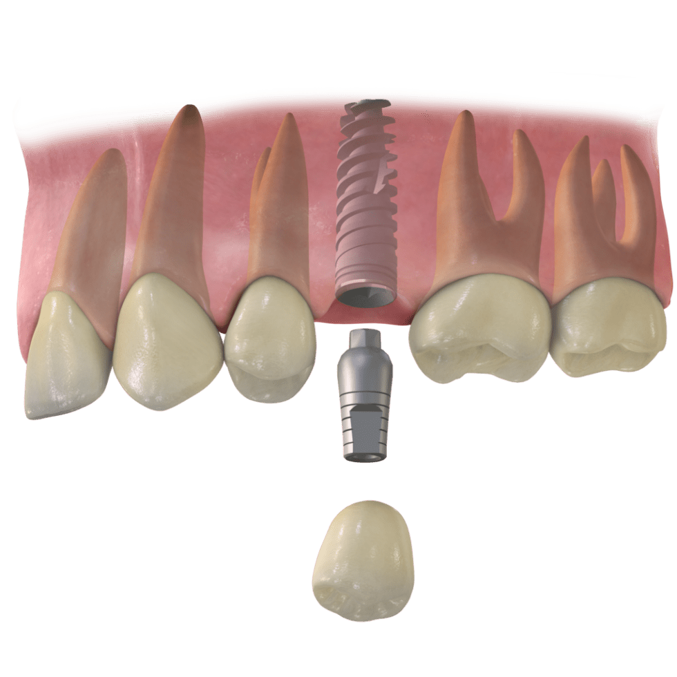 implantes dentales Castellon simulacion Implantes din hueso - Almela Clínica Dental
