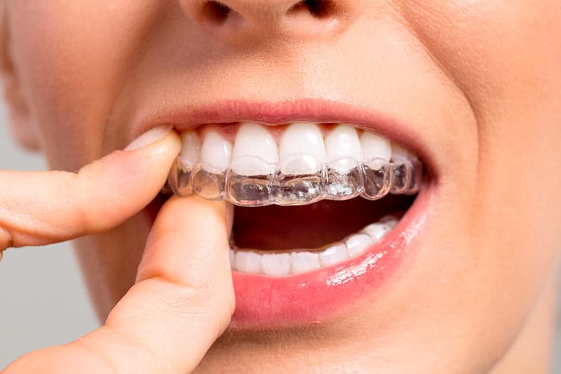 ortodoncia invisible proceso - Ortodoncia Invisible Castellón - Almela Clínica Dental, Castellón