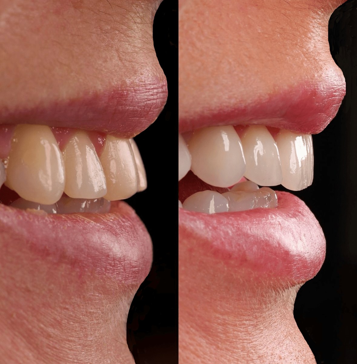Sonrisa Antes y Después - Almela Clínica Dental, Castellón