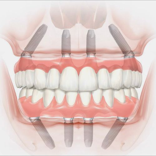 Implantes all on 4 - Almela Clínica Dental, Castellón