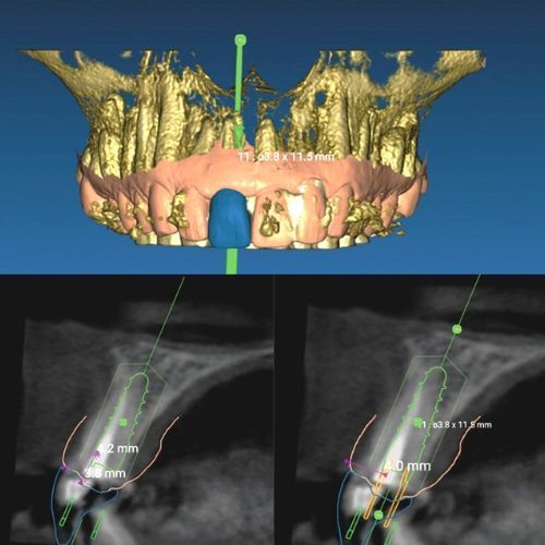 implantes sin cirugia