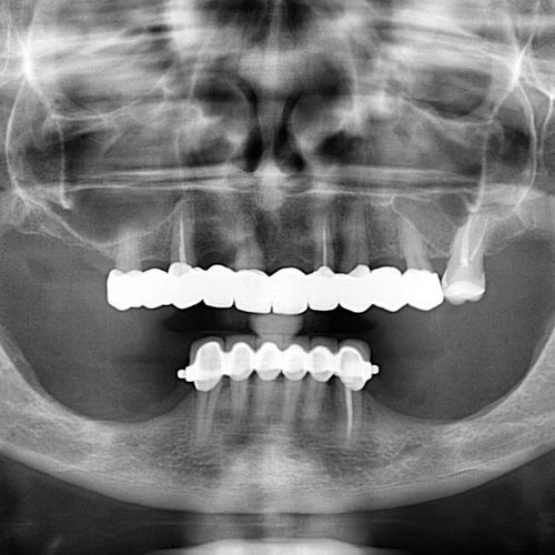 Implantes din hueso - Almela Clínica Dental, Castellón