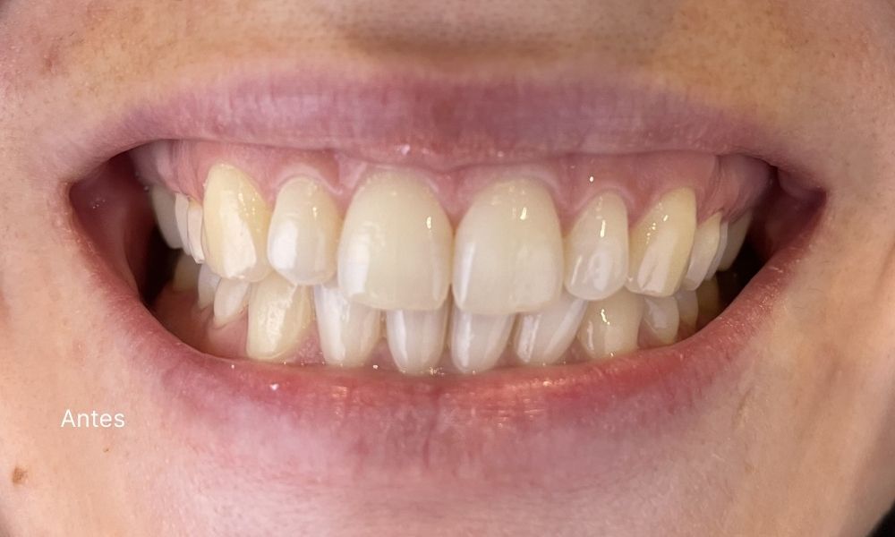 BLANQUEAMIENTO ANTES - Almela Clínica Dental, Castellón