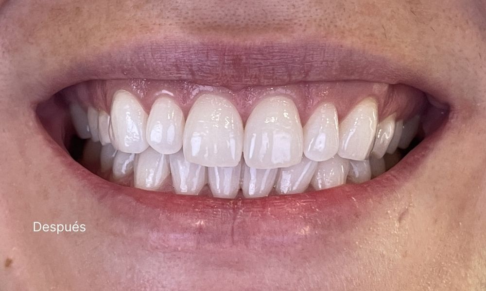 BLANQUEAMIENTO DESPUES - Almela Clínica Dental, Castellón
