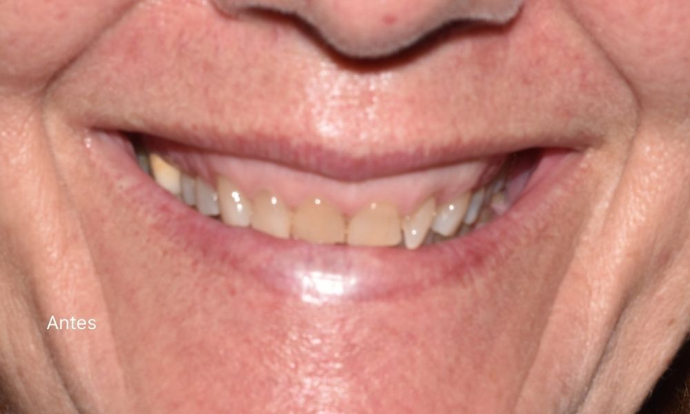 CARILLAS ANTES - Almela Clínica Dental, Castellón