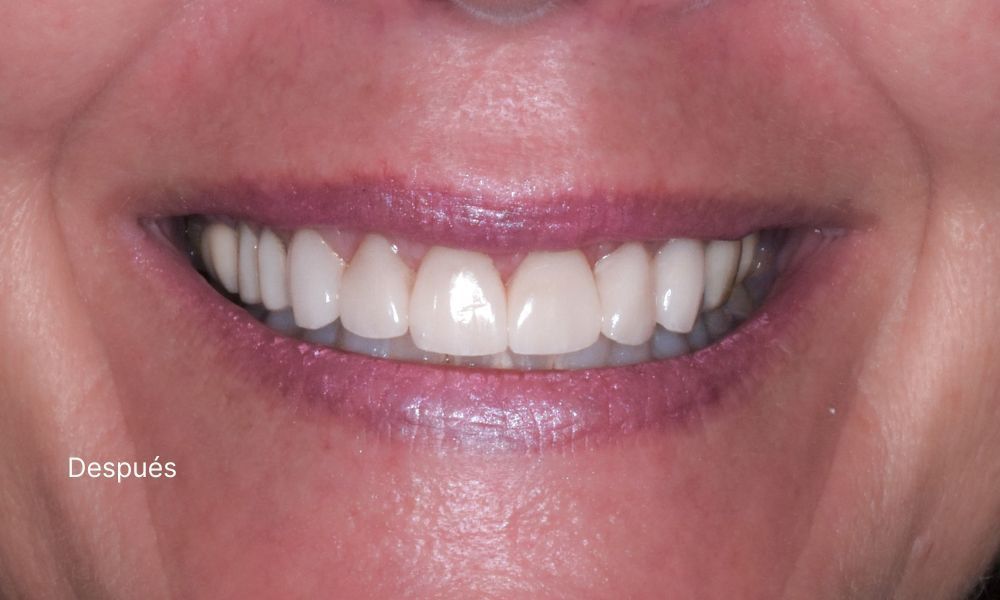 CARILLAS DESPUES - Almela Clínica Dental, Castellón