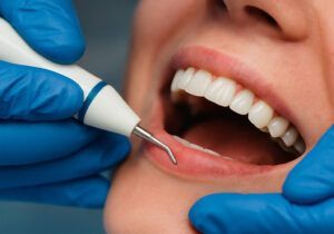 limpieza dental castellon clinica almela